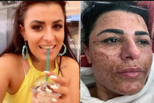 Esteticista queima rosto de cliente durante briga com o namorado pelo celular