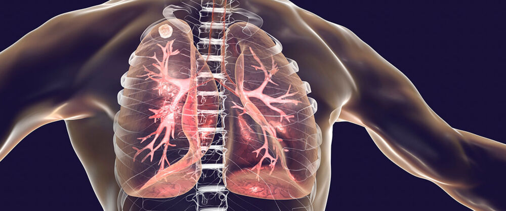 Dia Nacional do Combate à Tuberculose vem em forma de alertar e conscientizar o público