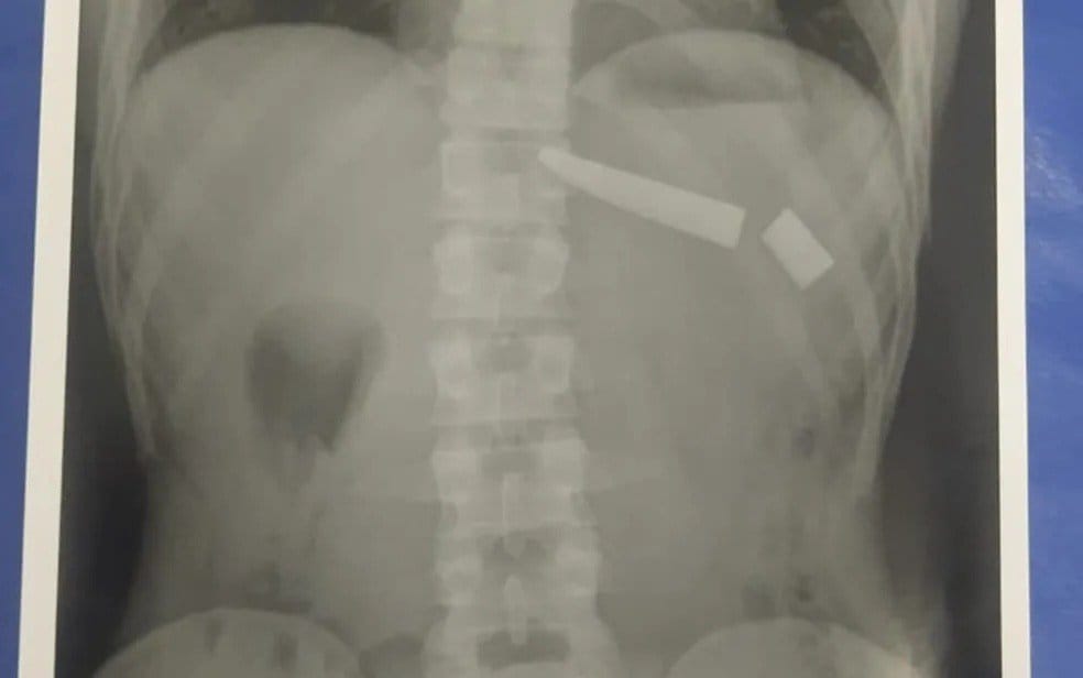 Homem passa por cirurgia após faca quebrar no tórax em briga