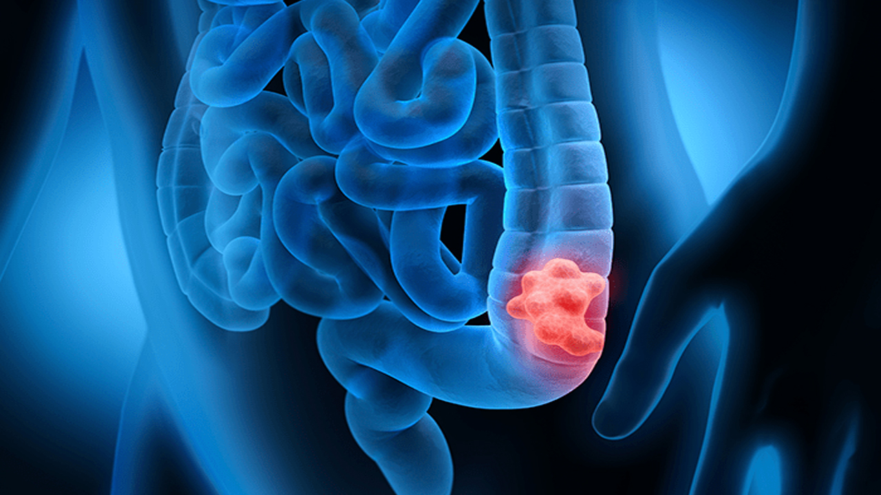 Internação por câncer de intestino cresce 64% em uma década