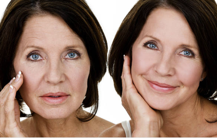 Botox, o procedimento queridinho para o dia das mães