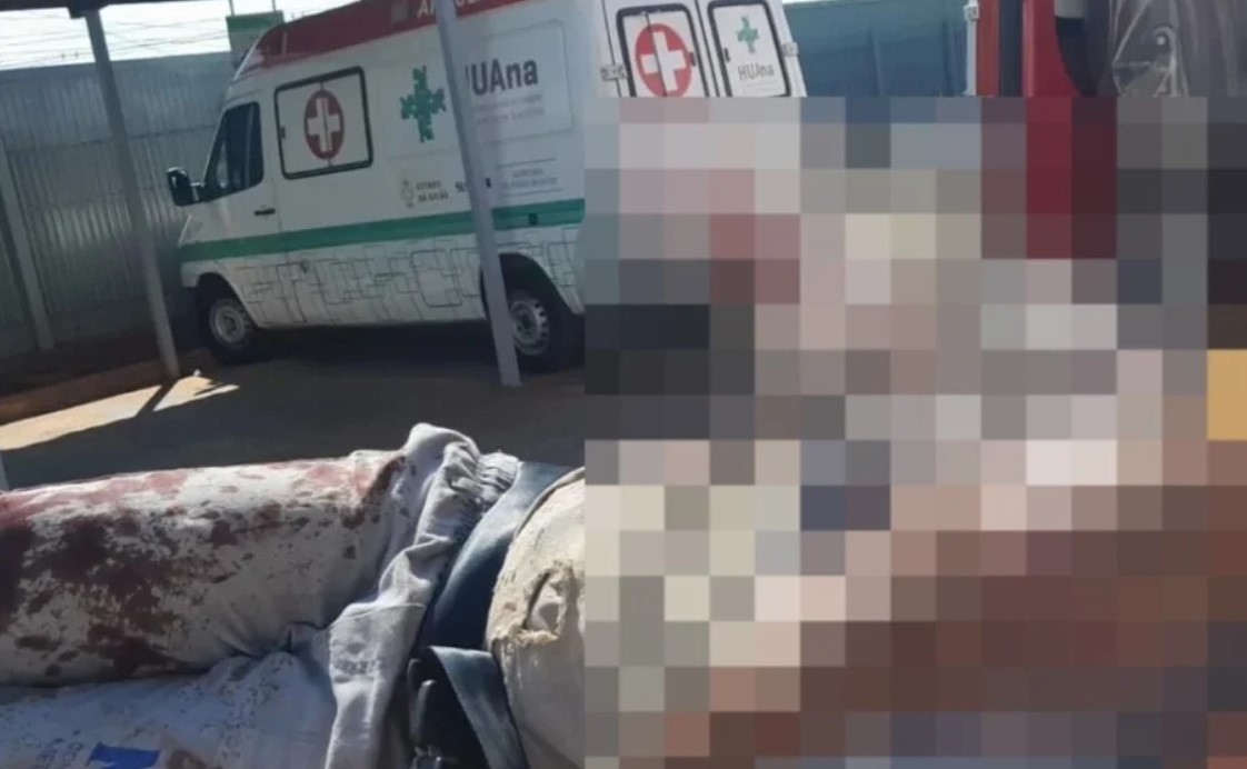 Homem tem braço amputado durante trabalho em metalúrgica