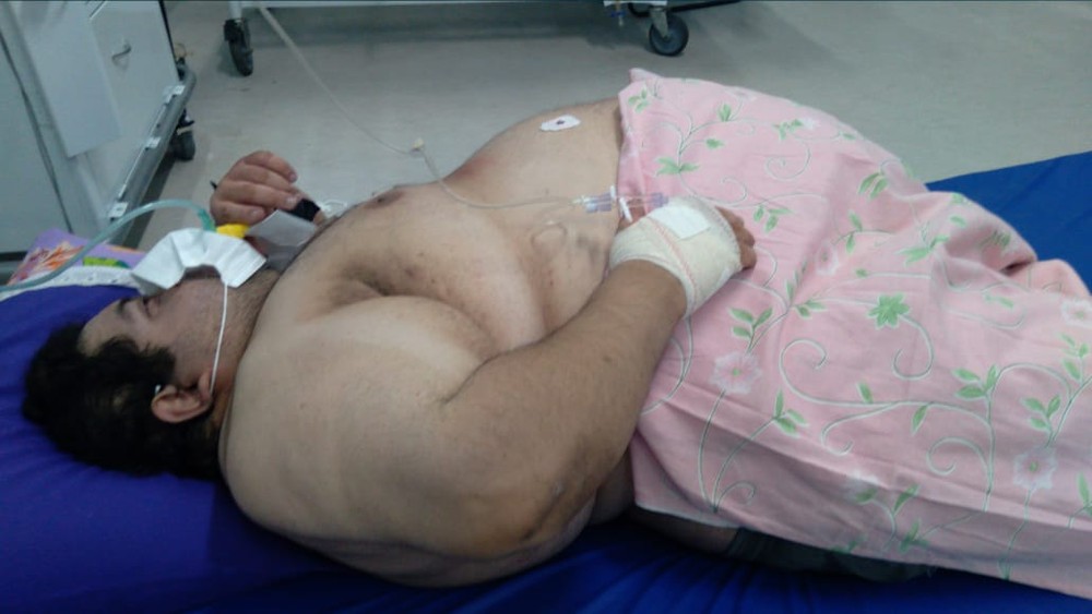Gordura no fígado aumenta em 5 vezes o risco de morte de pacientes obesos com COVID