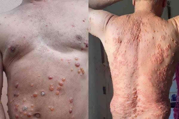 Homem desenvolve bolhas por todo o corpo após pegar Covid-19