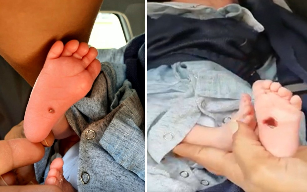 Bebê teve os pés queimados em incubadora de hospital em Goiânia