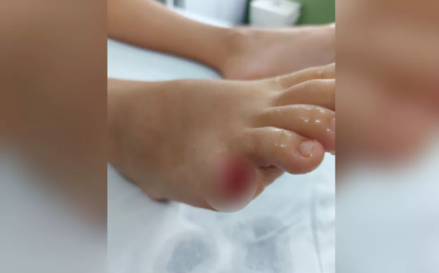 Criança de 10 anos perde dedo do pé após ser atacada por piranha no Lago das Brisas