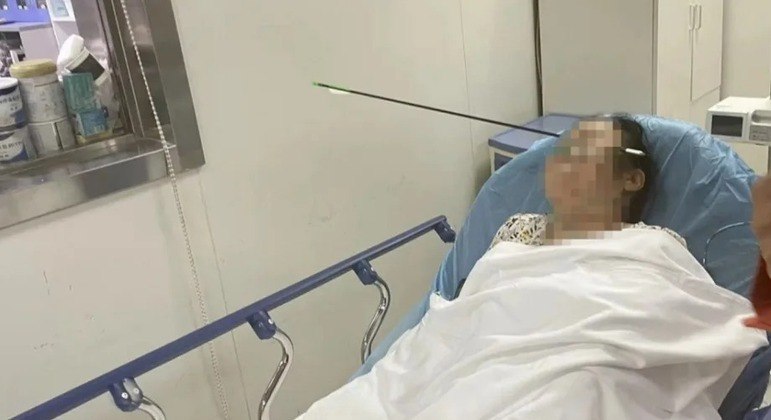 Flecha de 70 cm atinge cabeça de mulher, na China