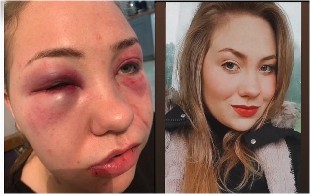 Jovem agredida por namorado na Irlanda diz estar se recuperando e "aliviada" após a  prisão dele
