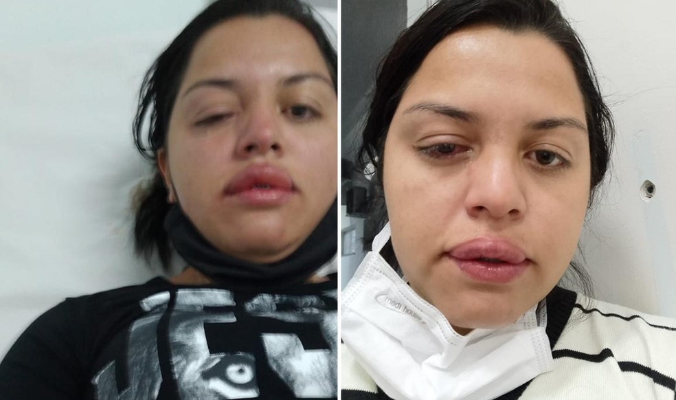 SP: Faxineira atacada com ácido pelo ex-patrão teme perder a visão de um olho
