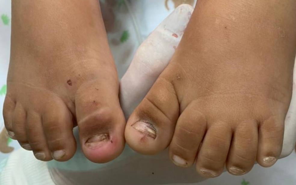 Polícia investiga maus-tratos a criança que precisou retirar 40% do intestino, em Goiânia