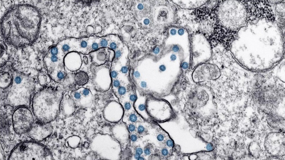 Variante Delta pode causar mais reinfecções