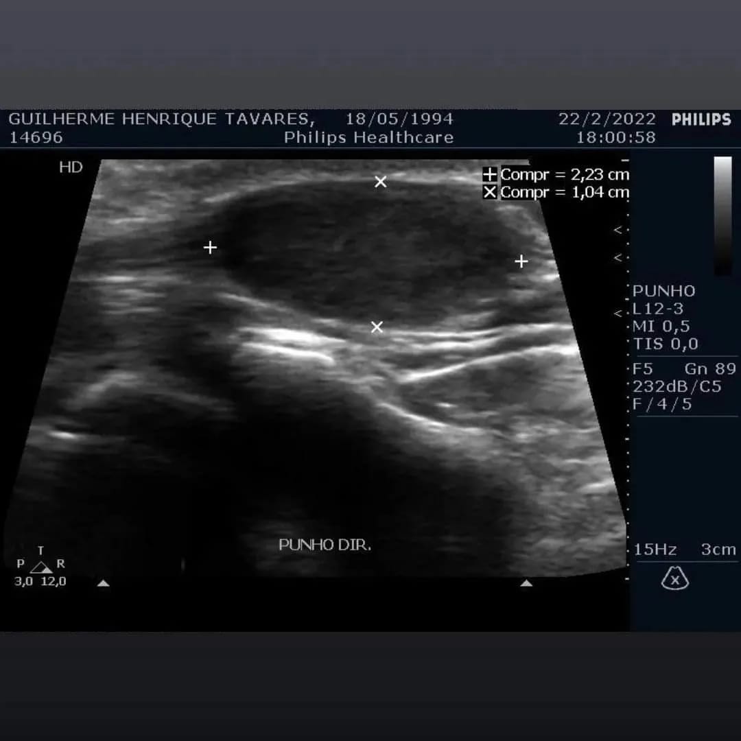 Jovem com tumor cria 'vakinha' para arrecadar dinheiro para cirurgia