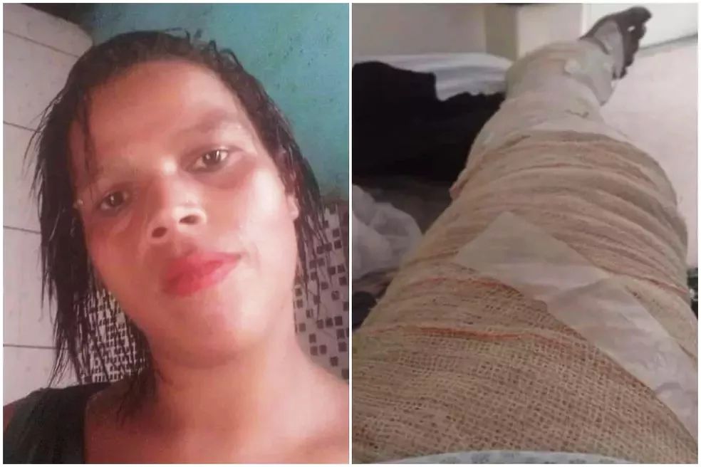 Jovem sofre graves queimaduras após usar álcool para cozinhar
