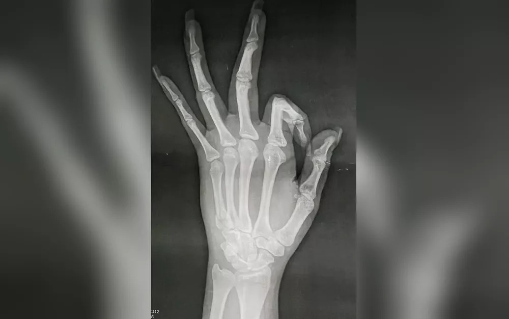Mulher denuncia que teve mão quebrada por ex-namorado