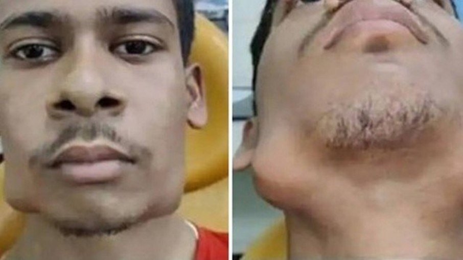 Jovem de 17 anos passa por cirurgia para retirar 82 dentes