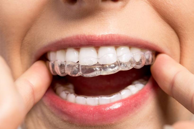 Aparelho dental invisível é técnica alternativa para tratamento convencional