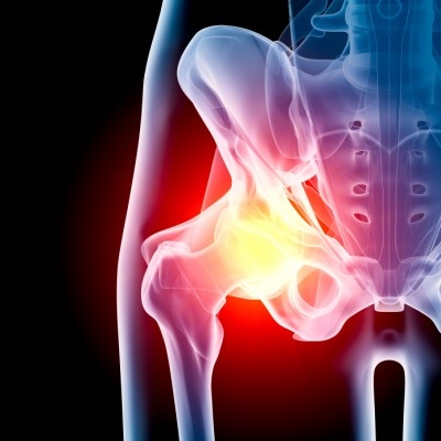 Nova técnica para cirurgia de quadril abrevia recuperação