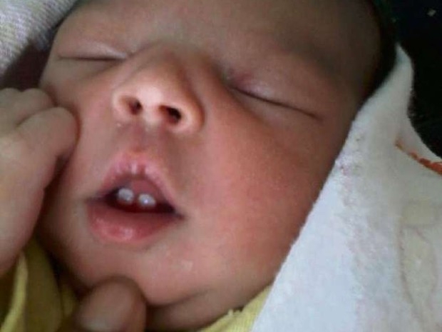 Bebê nasce com dois dentes em Colatina no ES