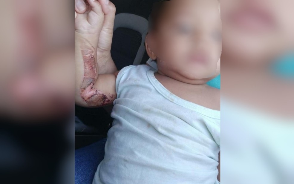 Criança é resgatada dos pais após sofrer queimaduras com carvão de narguilé