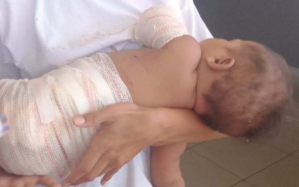 Bebê é atingida por fogos de artifício, mãe relata: 'pensei que ela ia morrer'