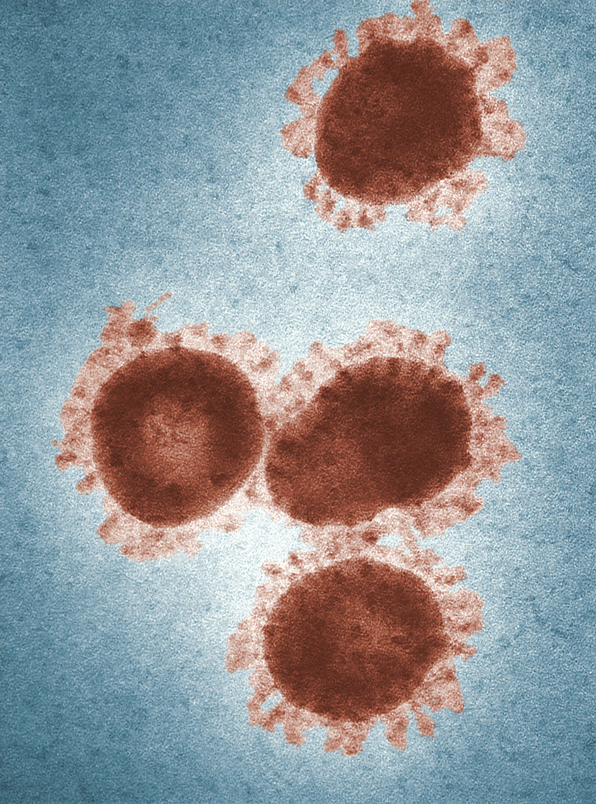Goiânia confirma primeiro caso de Flurona, infecção simultânea de Covid-19 e Influenza