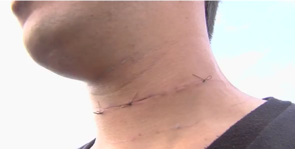 Homem é atingido por linha com cerol no pescoço e leva 12 pontos em Goiânia