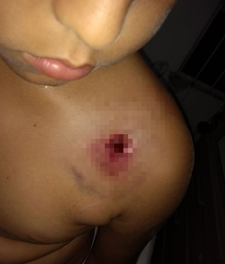Criança é atingida por tiro de bala de borracha em operação policial