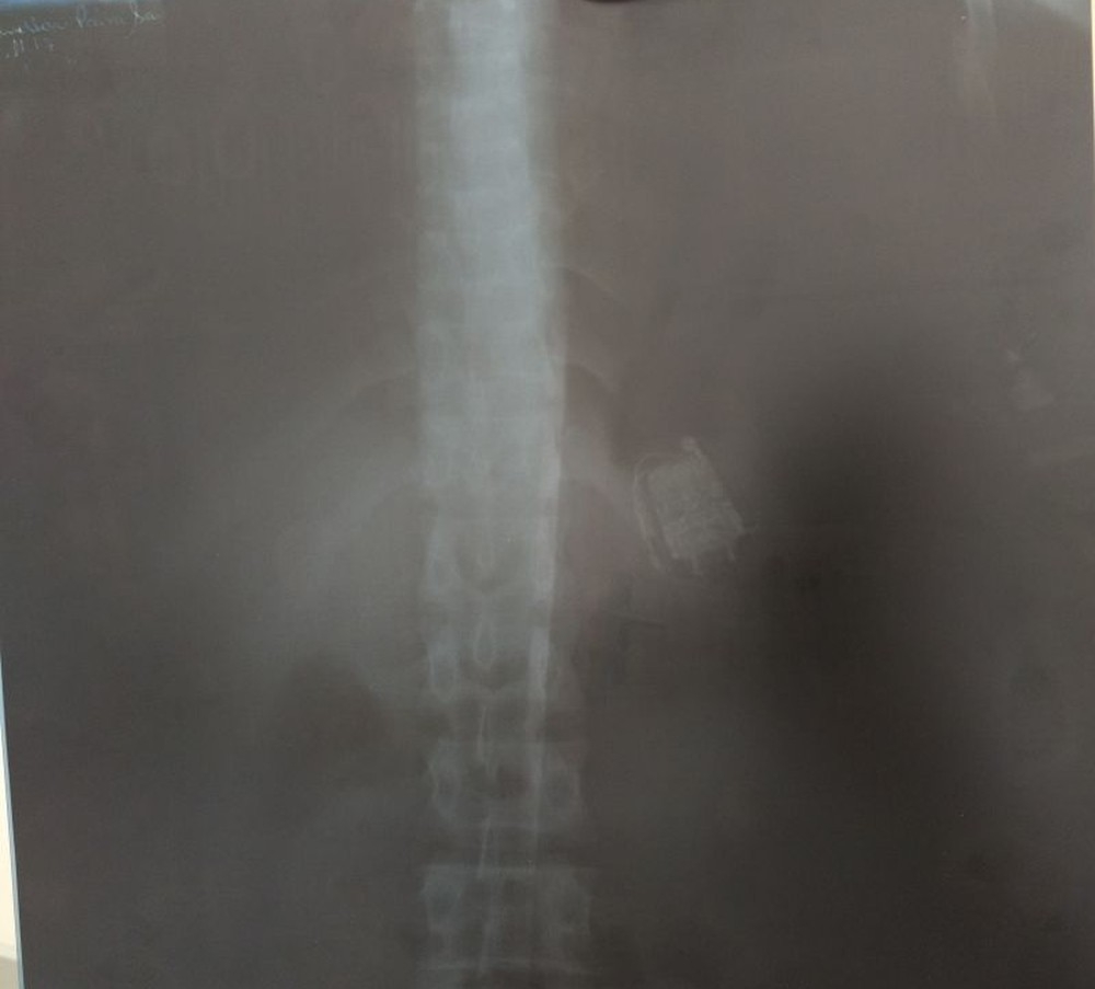 Detento com celular alojado no estômago passará por cirurgia
