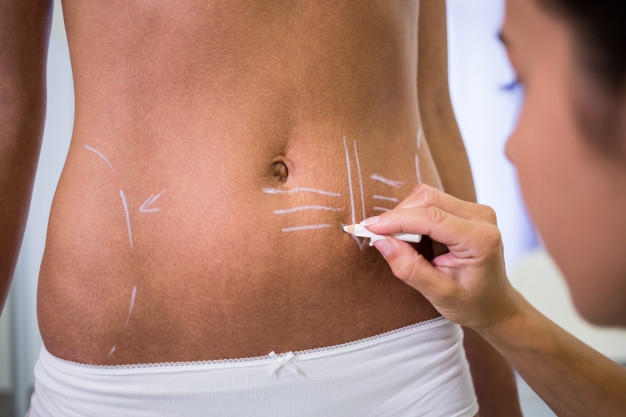 Lipoaspiração LAD: técnica que conquistou famosas precisa de boa indicação