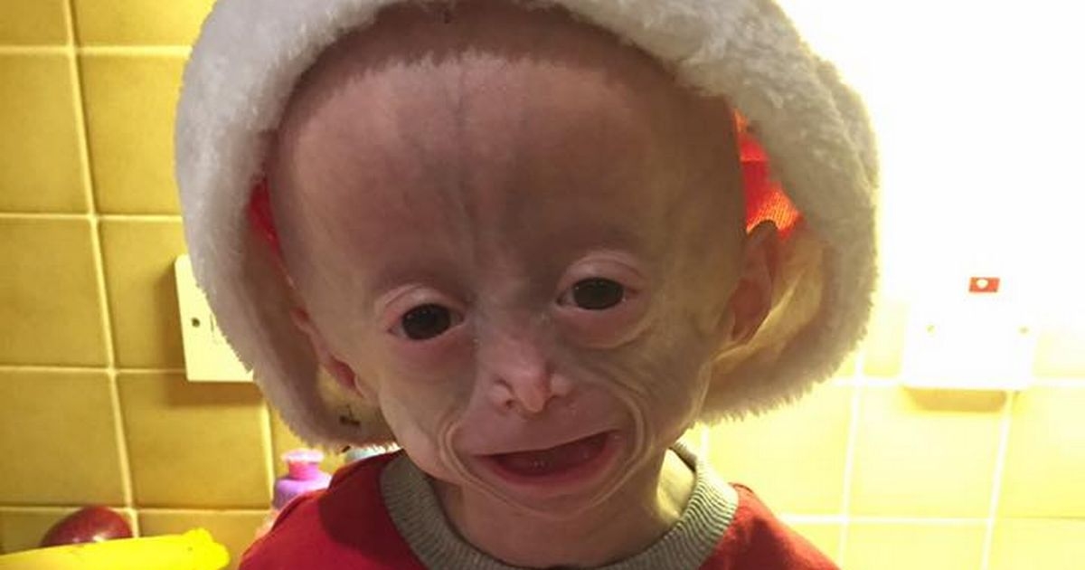 Morre menina com doença rara que a envelhecia 8 vezes mais rápido