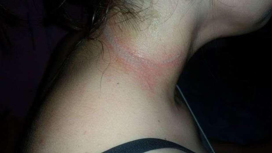Menina de 13 anos sofre queimaduras de 2º grau causada por celular