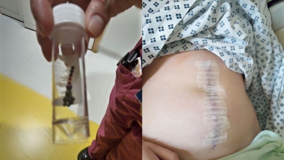 Menina de 13 anos tem parte do intestino removido após fazer desafio do TikTok