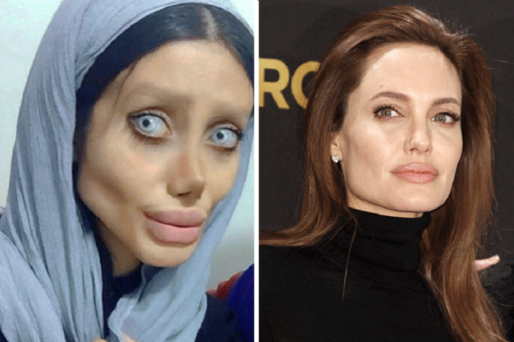 Iraniana faz 50 plásticas para ficar parecida com Angelina Jolie