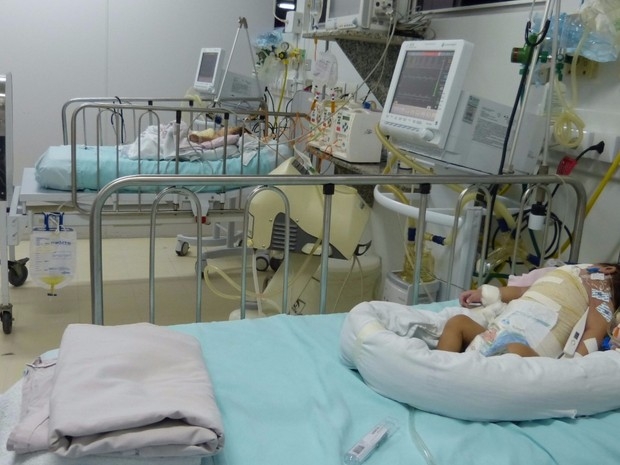Cirurgia de separação de gêmeas siamesas é realizada com sucesso