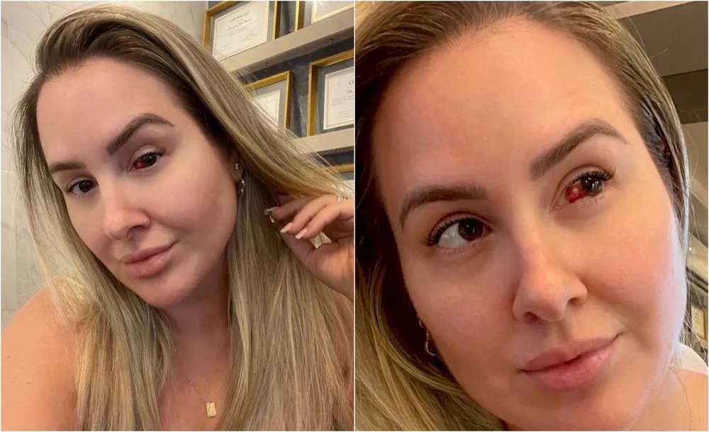 Ex-BBB Patrícia Leitte é diagnosticada com derrame ocular