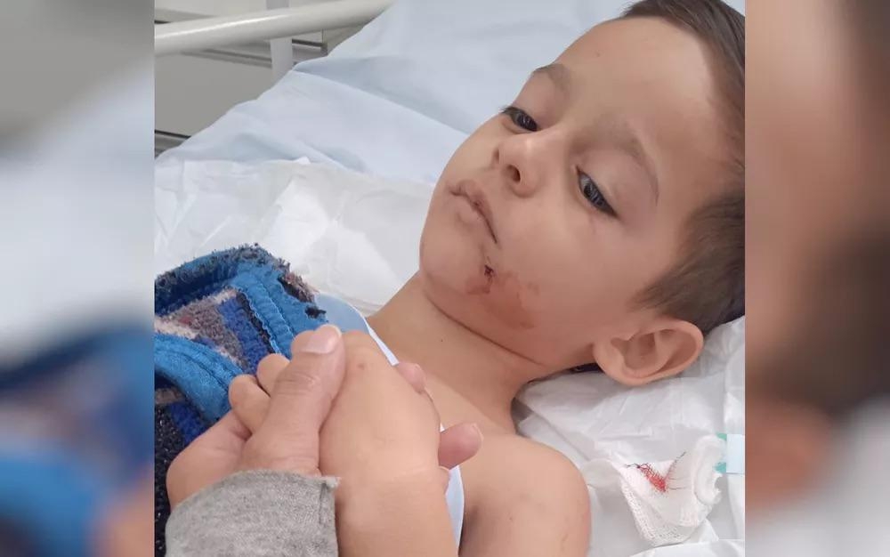 Criança que foi atacada por rottweilers na casa da babá precisa voltar a hospital minutos após receber alta