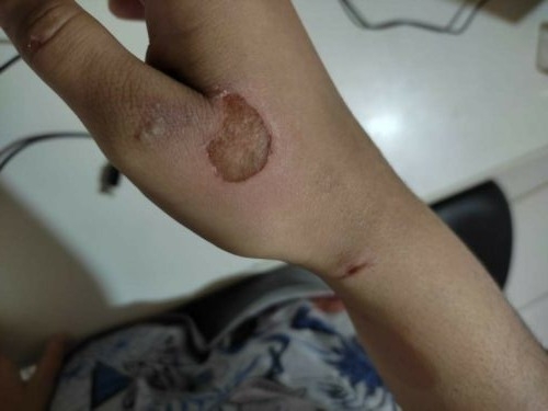 Homem é preso suspeito de agredir e atear fogo em companheira