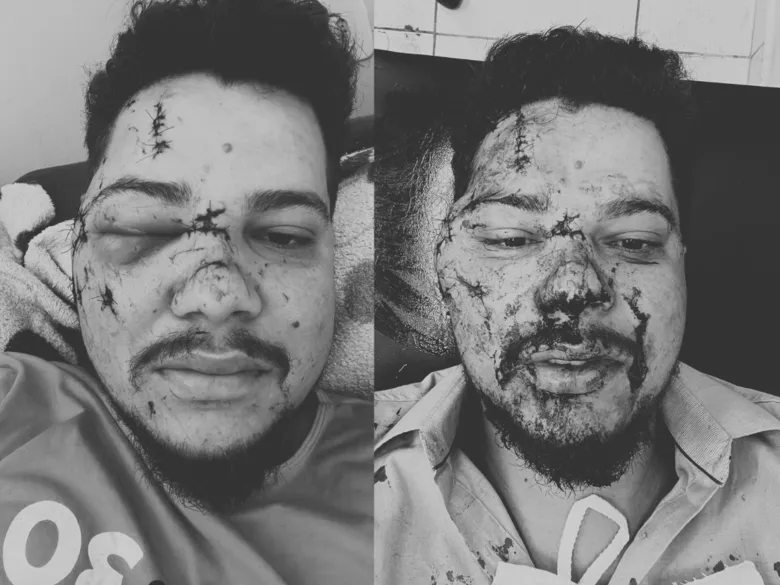 Cantor sertanejo fica com rosto desfigurado após ser agredido com garrafa em show