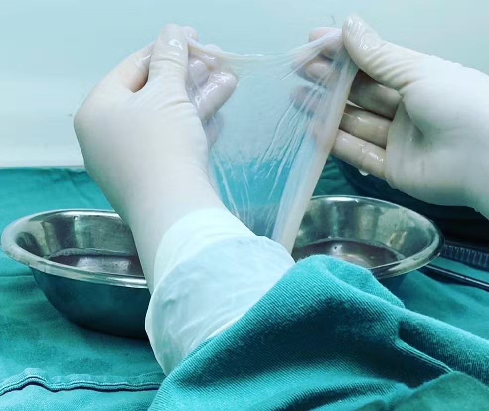 Membrana amniótica poderá ser usada no tratamento de queimaduras no SUS