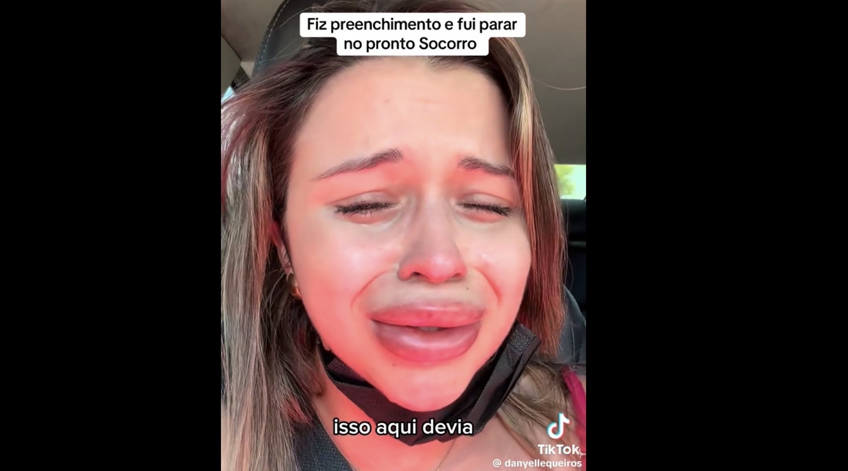Mulher se arrepende após preenchimento labial e alerta seguidores