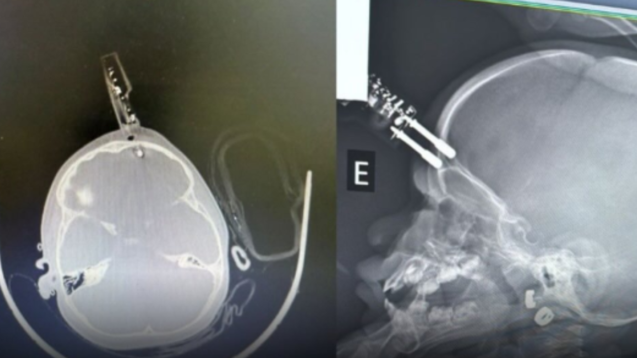 Bebê de 1 ano passa por cirurgia após queda com carregador cravado na testa em MG