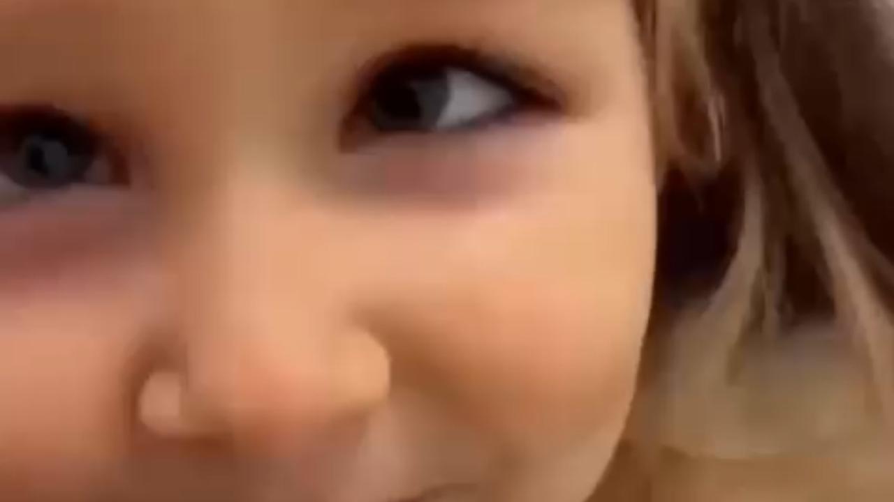 Vídeo: Cirurgia corrige estrabismo de criança e resultado emociona nas redes sociais