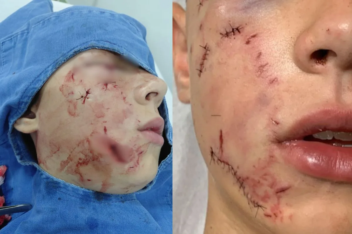 "Se ele estivesse sozinho, não teria sobrevivido", diz pai de menino de 10 anos atacado por pitbull em Anápolis
