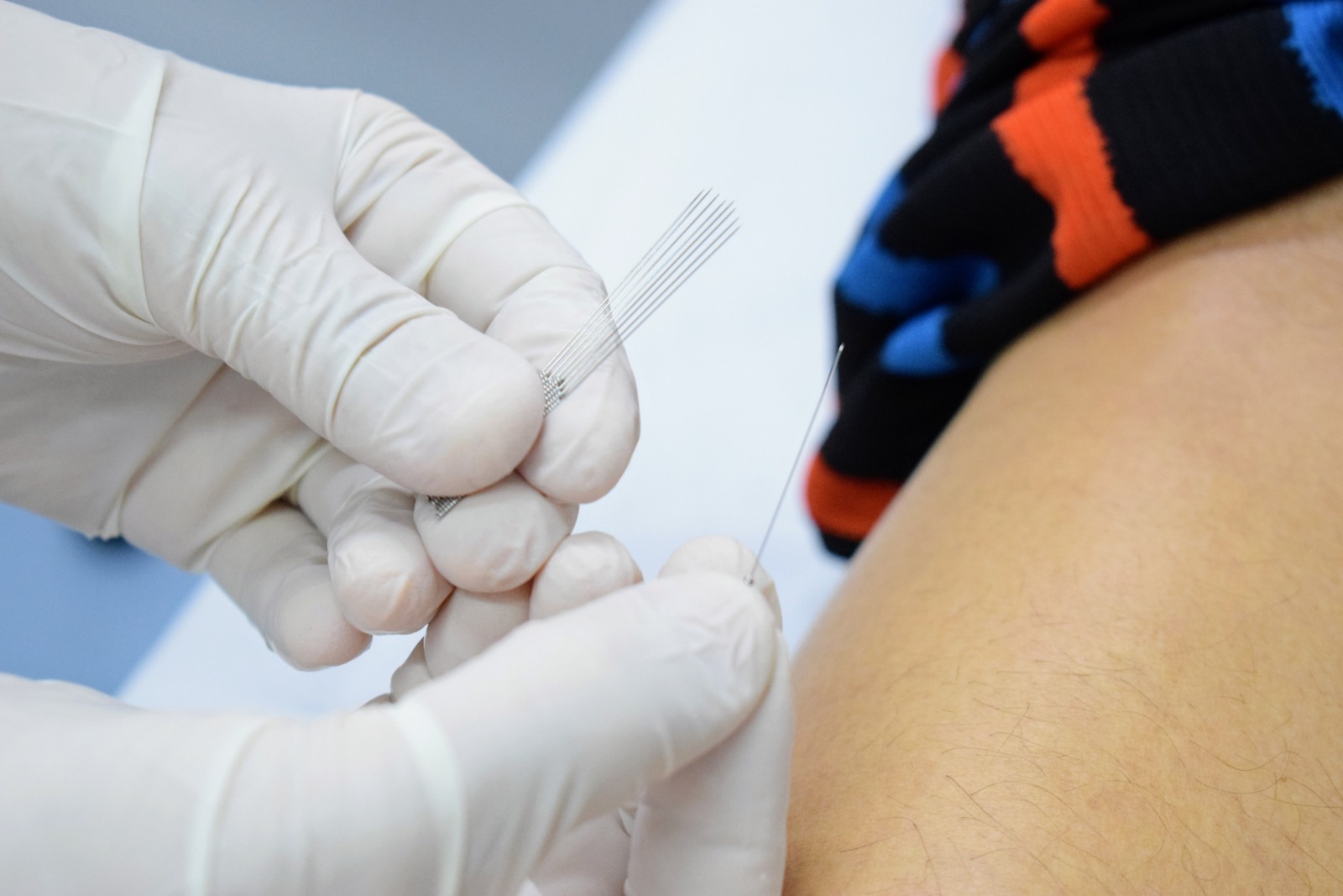 HDT supera dois mil atendimentos em ambulatório de acupuntura para colaboradores