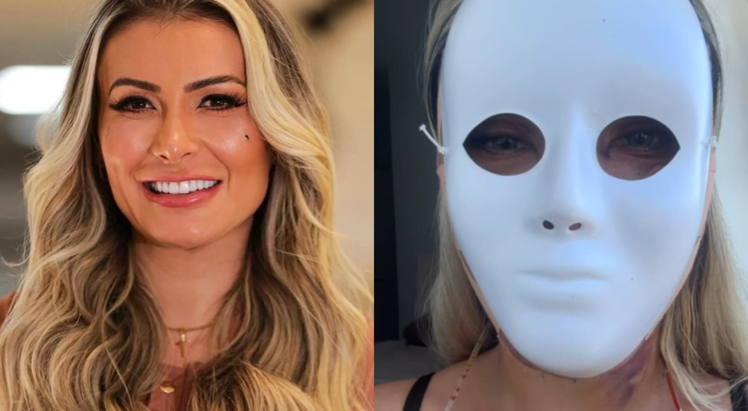 Cirurgia plástica: Andressa Urach gasta R$ 100 mil para fazer 'novo rosto'