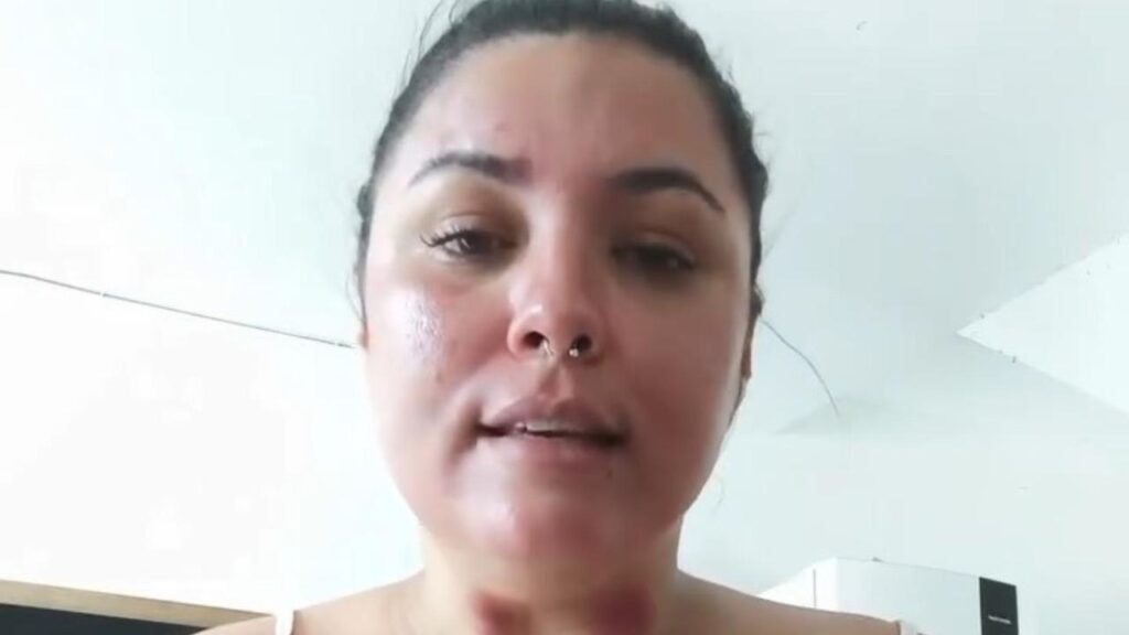 Mulher com marcas roxas relata ciúmes do marido após passar noite em hospital com amiga; veja vídeo