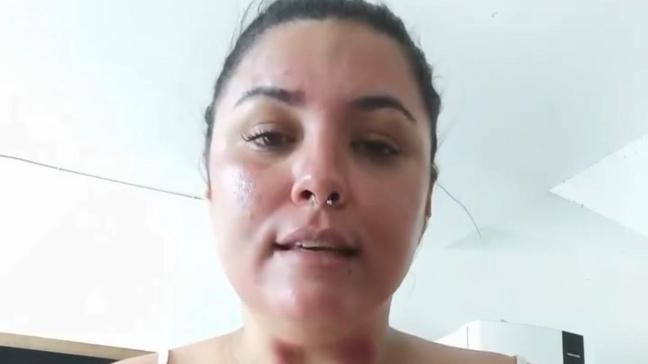 Mulher com marcas roxas relata ciúmes do marido após passar noite em hospital com amiga; veja vídeo