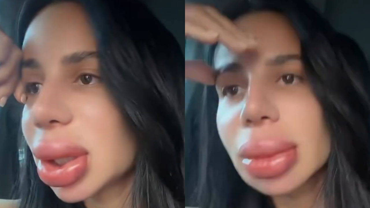 Mulher revela desconforto após remoção de preenchimento labial: "Até beber água foi difícil"; veja vídeo