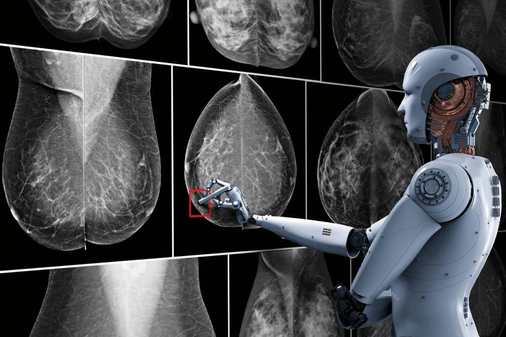 Inteligência artificial identifica câncer de mama anos antes do diagnóstico