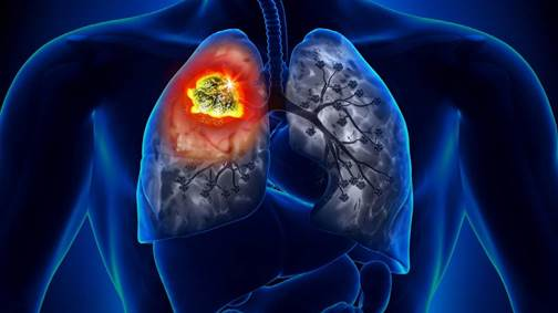 Tosse persistente e falta de ar podem ser sinais de câncer de pulmão, alerta pneumologista
